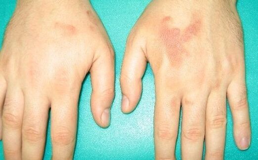 a kéz ízületeinek fájdalma a paraziták tünetei lehetnek