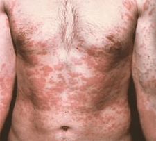 a problémás bőr a paraziták jelenlétének tünete