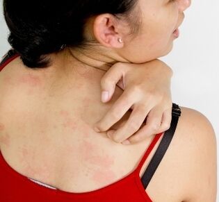 granulomák a testen - a paraziták jelenlétének tünetei