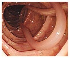 paraziták az emberi szervezetben